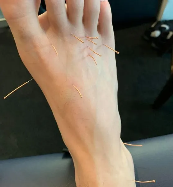 Feet dry needling