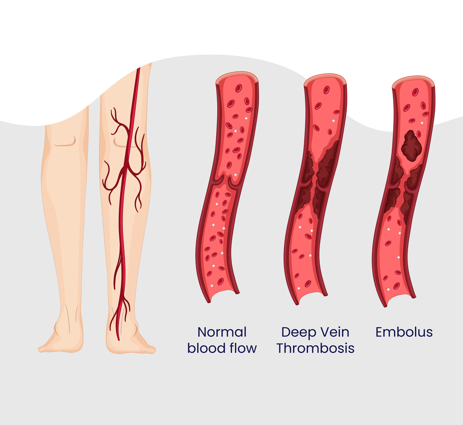 Deep Vein Thrombosis DVT